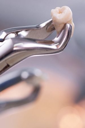 Multiple Tooth Extraction: How To Prepare And Proper Aftercare Tips