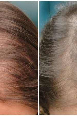 What is Surgical Restoration of Hair