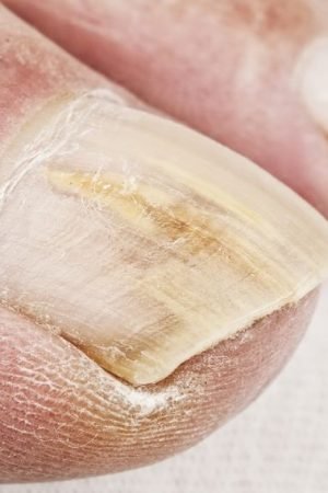 Cause and Treatment Options for Fungal Nail Infection