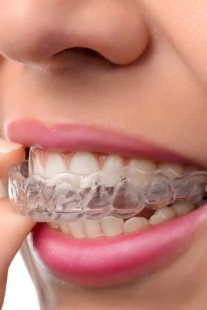 The Pros of Getting Invisalign