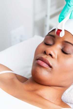 Naturally Eliminating Scars and Wrinkles with Skin Needling