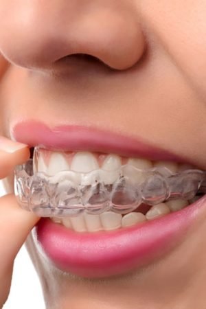 5 Invisalign Hacks That Will Blow Your Mind