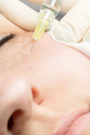 Evaluate the Condition Before Undergoing Undereyes Botox