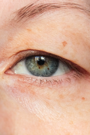 Eyelid Drooping: What is it and The Reasons, Symptoms, and Treatment