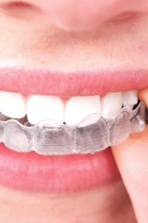 Invisalign Ottawa For The People Who Need It So Eagerly