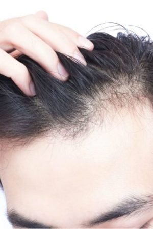 What Are Some Remedies for Hair Loss in 21-year-Old Men?