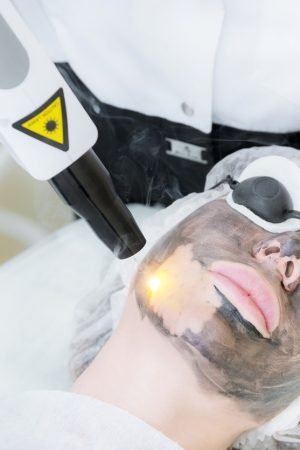 Carbon Laser Peel: A Non-invasive Laser Treatment Option in Singapore