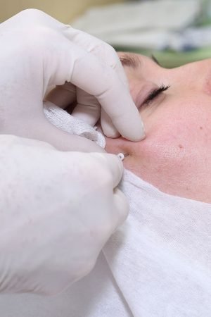 Threadlift in Singapore: The Lowdown on this Popular Treatment