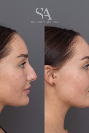 Understanding Neck Liposuction: What to Expect in NYC