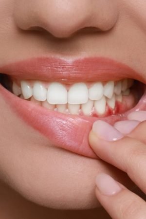 Gum Disease